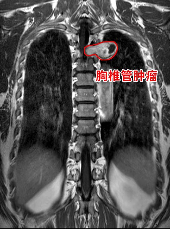 胸部肿瘤