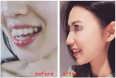 32岁的她做了牙齿矫正，竟然年轻好几岁！