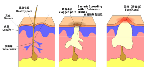 不含酒精的水杨酸面膜博乐达诚招各地市代理