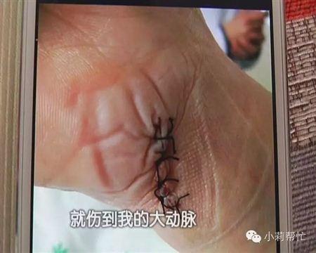 郑州女子洗澡时玻璃门突然爆炸 差点划破大动脉