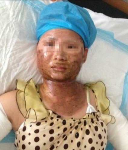 25岁美丽孕妇试燃气大面积烧伤 请人拨120遭拒