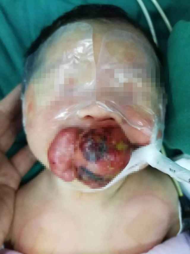 宝宝出生嘴巴被“它”堵着 手术后终于露出孩子真容