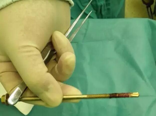 10厘米长钢钉插入3岁小孩鼻孔 险伤及眼球