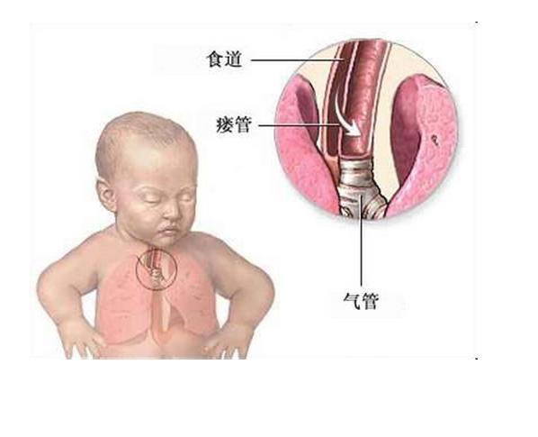 紧急气管切开术位置图片