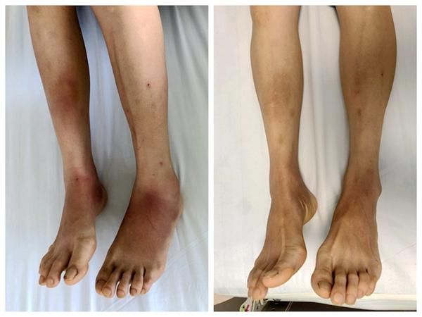 湖南一女子腿长红斑发抖怕冷 原来糖尿病是感染结核的"温床"