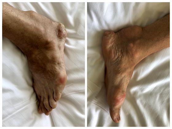 常德男子痛风30年手脚长满"石头" 治疗后称还想喝口白酒