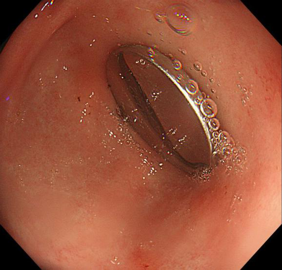 邵阳3岁宝宝误吞纽扣电池 在胃内停留1天半送长沙抢救