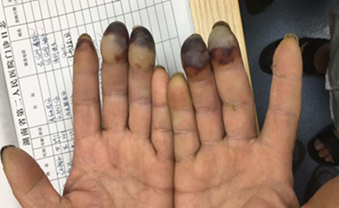 看着都疼湖南男子在冰库工作两天后手指被冻致发黑溃烂