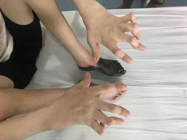 22岁女孩体重仅23公斤脚穿"黑套袜" 只因患上脉管炎致左脚坏死