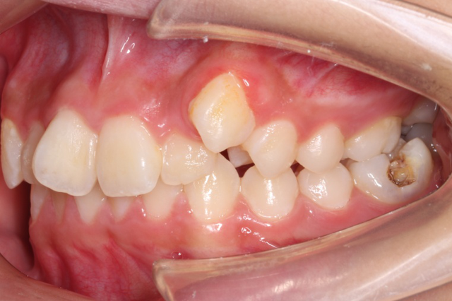 长沙14岁少女越长越丑母亲怀疑抱错孩