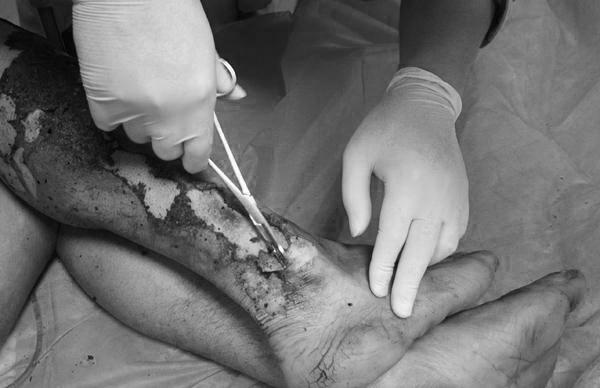 怀化一62岁男子被雷击伤口焦黑未脱离危险图