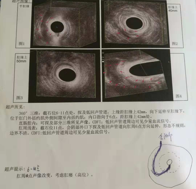 長沙39歲男子菊花腫痛流膿15年送醫後查出化膿性汗腺炎