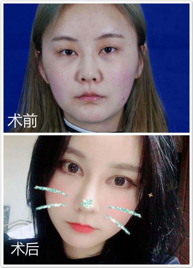 小眼睛妹子被分手後怒割雙眼皮 秒變混血芭比震驚前男友!