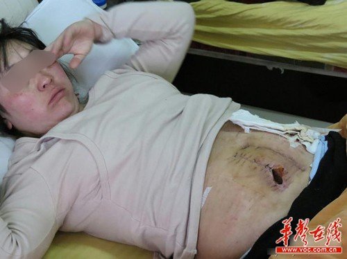 云南永善女子剖腹产 子宫遭切肚皮开裂(图)