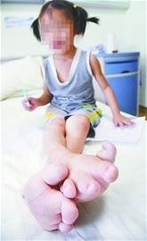 5岁女孩患先天性巨趾症 穿42码大鞋(图)