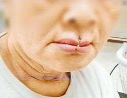 台湾精神病患老妇自缝嘴巴&nbsp;只因媳妇嫌唠叨