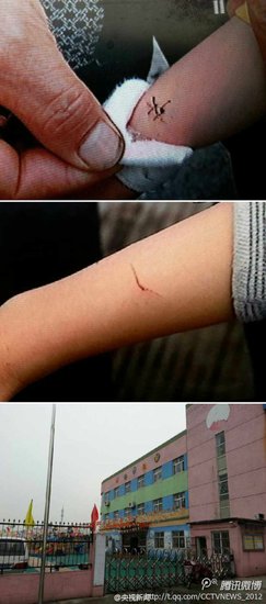 上海一幼儿园老师用剪刀剪伤7名孩子手腕(图)