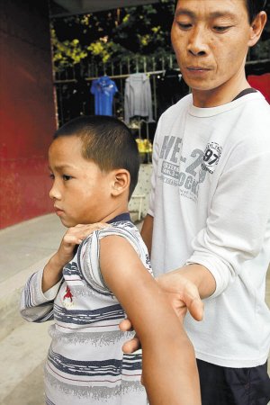 小杰的脸上和手臂有大块淤青。