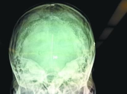 ct片下脑部的针.记者朴峰摄