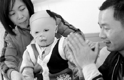 广东"面具娃娃"进京手术 医疗方案正在商讨