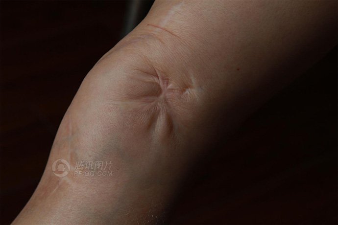 由于当时医疗条件差,刘吉英住院期间腿部伤口继续感染,使伤口生蛆