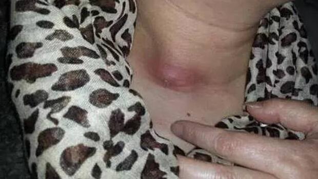 江苏女子吃鱼被卡半月后鱼刺从脖子冒出(图)