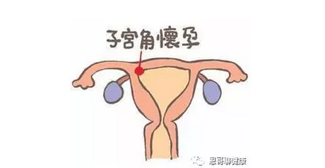 >> 文章内容 >> 宫角妊娠4例误诊分析 现在怀孕四个月了,之前检查是右