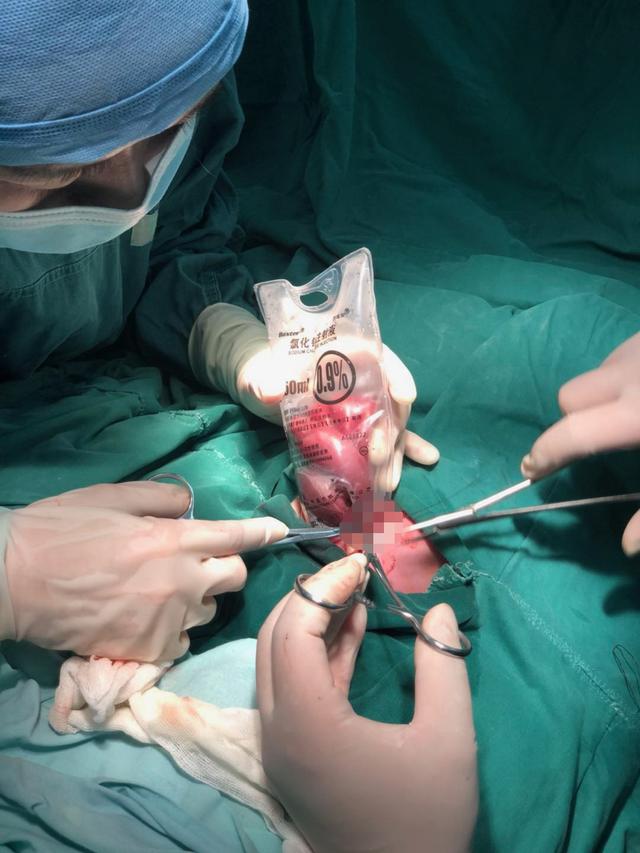 早产儿患腹裂 国家儿童医学中心两次手术成功救治