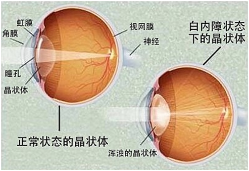 白內障的治療方法 白內障形成原因