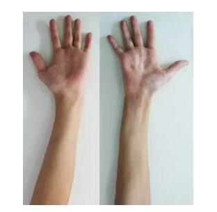 少年手部无力别轻视警惕平山病