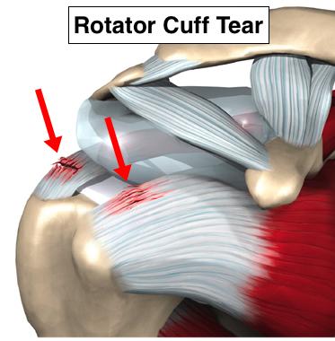 前方:科比右肩肩袖撕裂 无限期休战或将退役