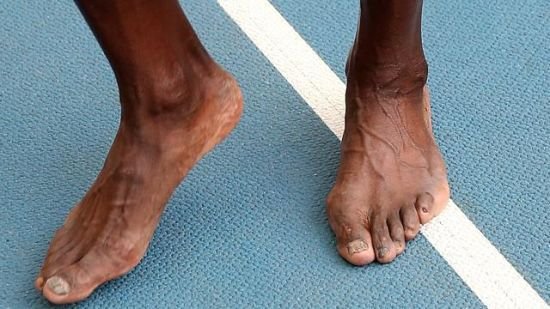 医生博尔特脚没大毛病练马拉松易拇指外翻