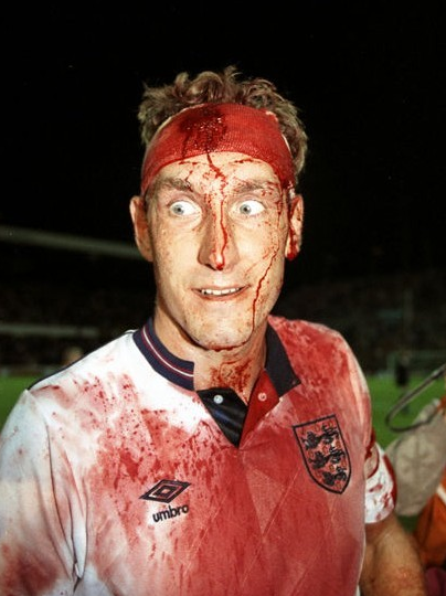 1990年世界杯预选赛对垒瑞典一役,布彻与北欧猛汉相撞后头部流血,简单