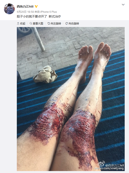照片中,他的双膝部分大片血渍,看起来十分血腥据其本人透露,这是