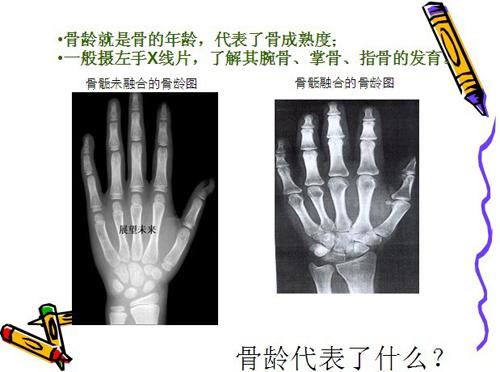 左手骨龄报告单怎么看图片