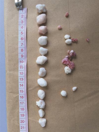 杭州16岁女孩爱打羽毛球 肩关节取出20多颗软骨瘤