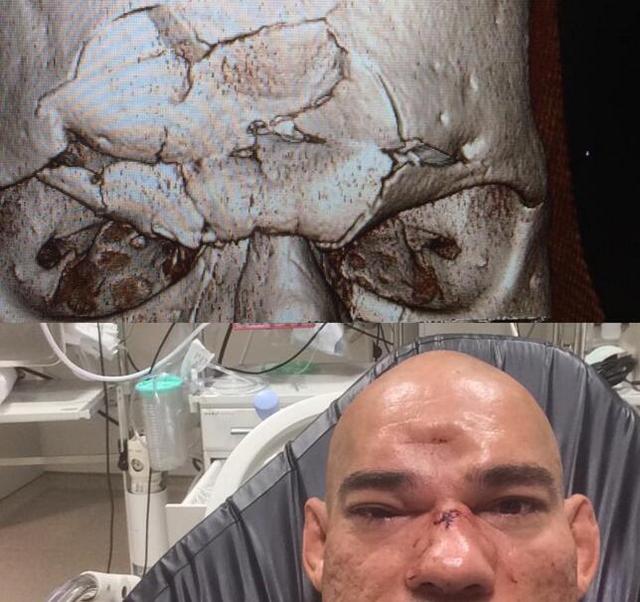 mma机械兽桑托斯遭惨烈ko一记飞膝致头骨碎裂