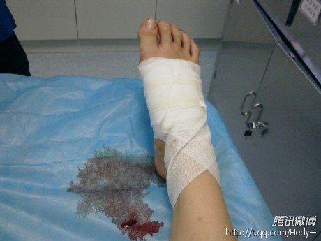 女孩子脚受伤图片