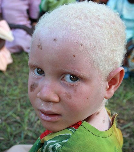 白化病图片 腾讯网