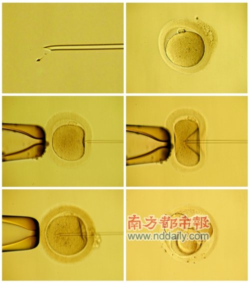 [导读]精子与卵子在实验室高倍显微镜下以"注射"的方式结合,俗称"试管