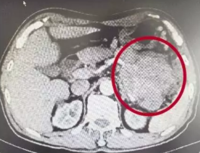 温州老伯腹痛一年 查出小西瓜大小的肿瘤