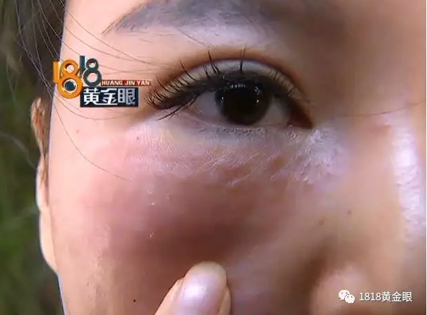 杭州一美女美容后脸红肿 带刀去找院长