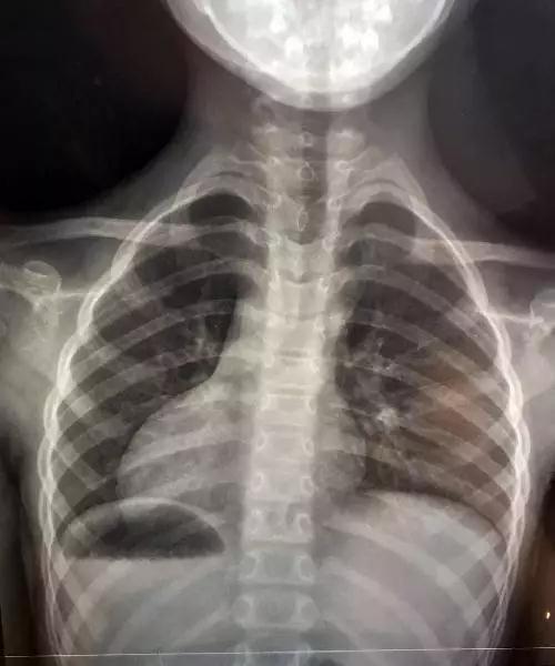 温州7岁女娃补牙遭意外 5厘米长针掉落肚内