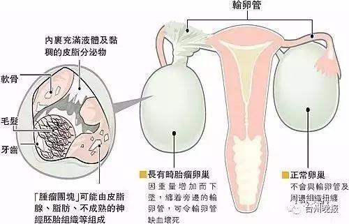 台州一女子"怀孕"17年 她肚子里的东西长头发有牙