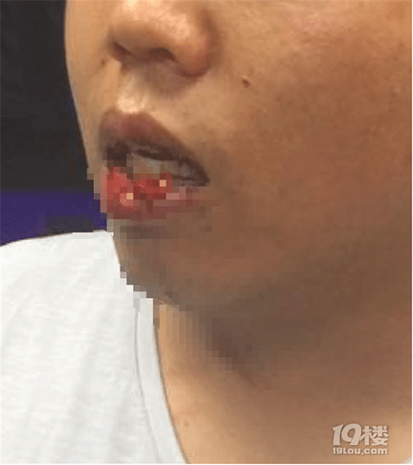 网约车司机在杭州灵隐景区被打 嘴上缝了14针