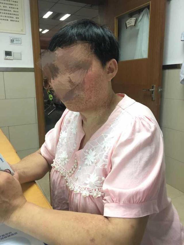 杭州女子疼了10多年 把全身皮肤刺成了马蜂窝