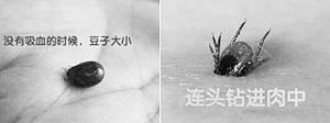 嵊州大妈高烧不退 急送杭州查出“恙虫”作祟