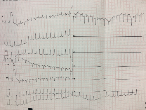 24岁孕妇心脏超速跳动 因为多了一根“电线”