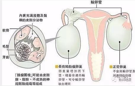 台州一女子产后已节育 17年后又犹如怀胎10月