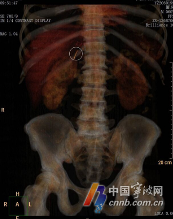 一根鱼刺“潜伏”肝胃间 宁波60岁大伯肚子痛了一周